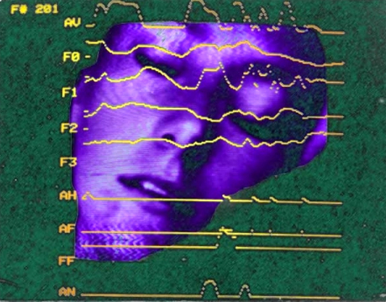 Philippa Cullen in composite with electromyogram, 1974